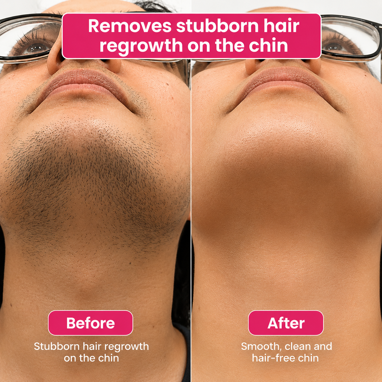 🔥LAST DAY 60% OFF Bangsbar Hair Reduction Oil 60 ml – Permanent Hair Removal Oil