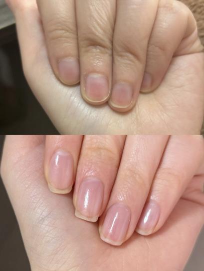 LOVILDS™ Extra Strength Toenail Fungus Treatment – Triple Action Antifungal Solution for Nail Repair & Renewal